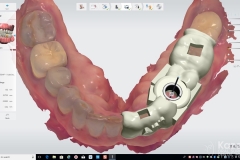 6.-digital-dental-implant-natrual-looking-easy-to-clean04