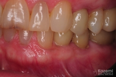 7.-digital-dental-implant-natrual-looking-easy-to-clean02