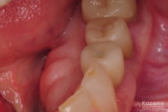 8.-digital-dental-implant-natrual-looking-easy-to-clean06