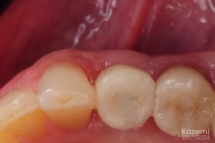 9.-digital-dental-implant-natrual-looking-easy-to-clean08
