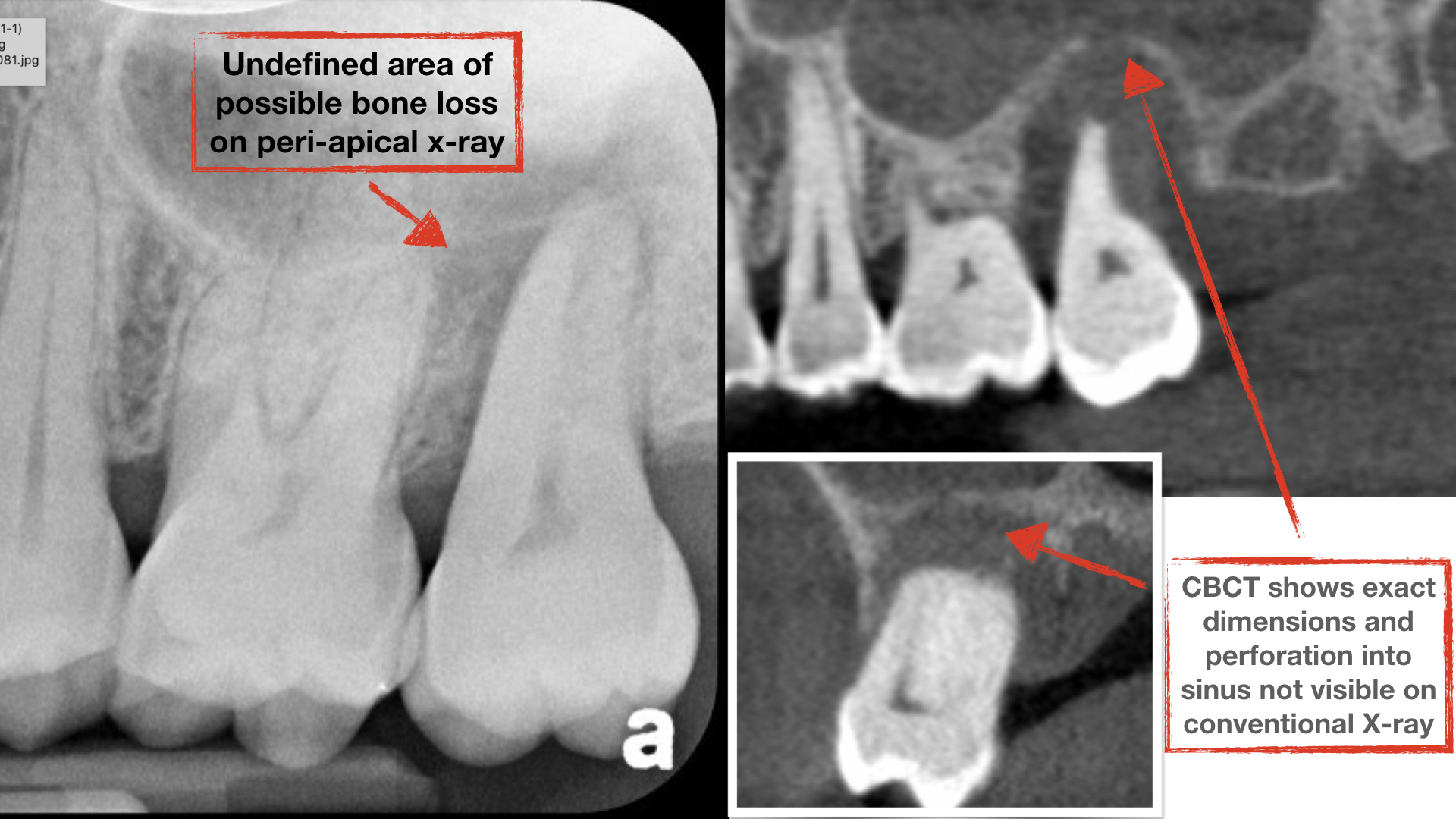 CBCT-benefits-in-diagnosing-tooth-infection-into-sinus-kazemi-oral-surgery-and-dental-implants