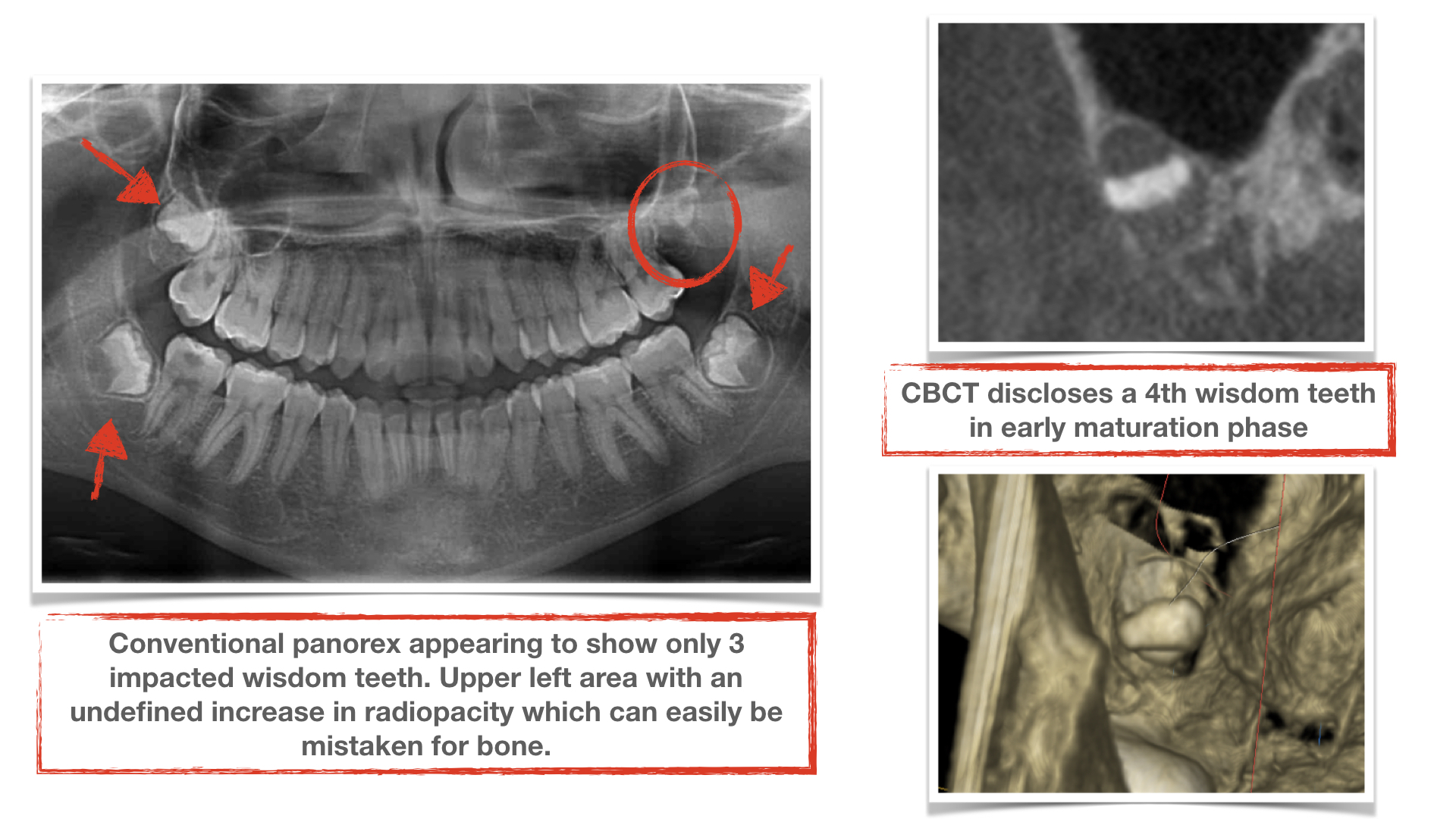 CBCT-benefits-in-finding-impacted-wisdom-teeth-kazemi-oral-surgery-dental-implants