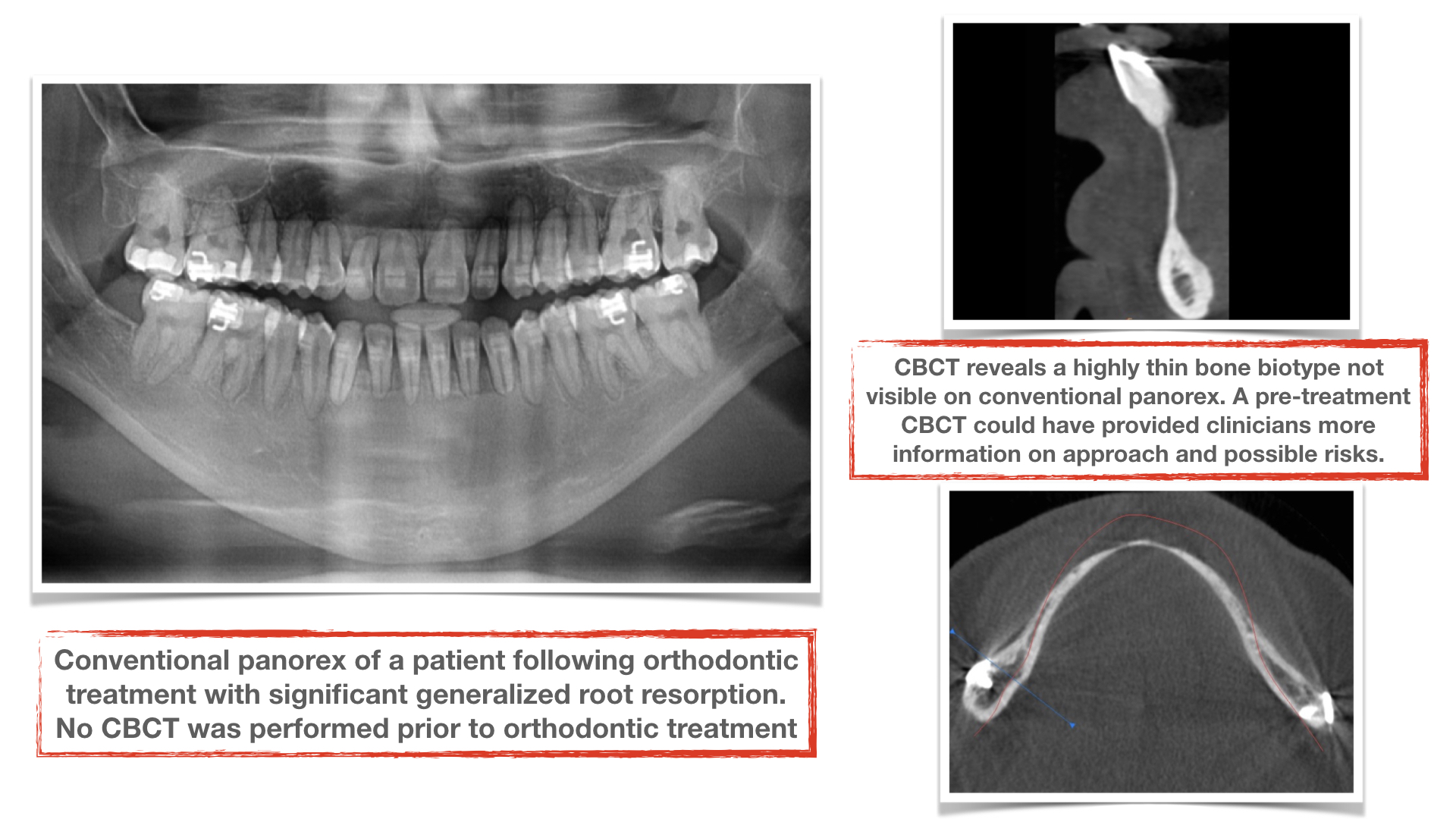 CBCT-benefits-in-orthodontic-treatments-root-resorption-kazemi-oral-surgery-and-dental-implants