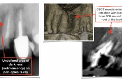 CBCT-benefits-in-diagnosing-bone-loss-around-a-tooth-not-visible-on-periapical-x-ray-kazemi-oral-surgery-and-dental-implants