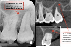 CBCT-benefits-in-diagnosing-tooth-infection-into-sinus-kazemi-oral-surgery-and-dental-implants