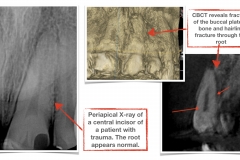 CBCT-benefits-in-diagnosing-tooth-root-fracture-not-visible-on-periapical-x-ray-kazemi-oral-surgery-and-dental-implants