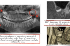 CBCT-benefits-in-finding-impacted-wisdom-teeth-kazemi-oral-surgery-dental-implants