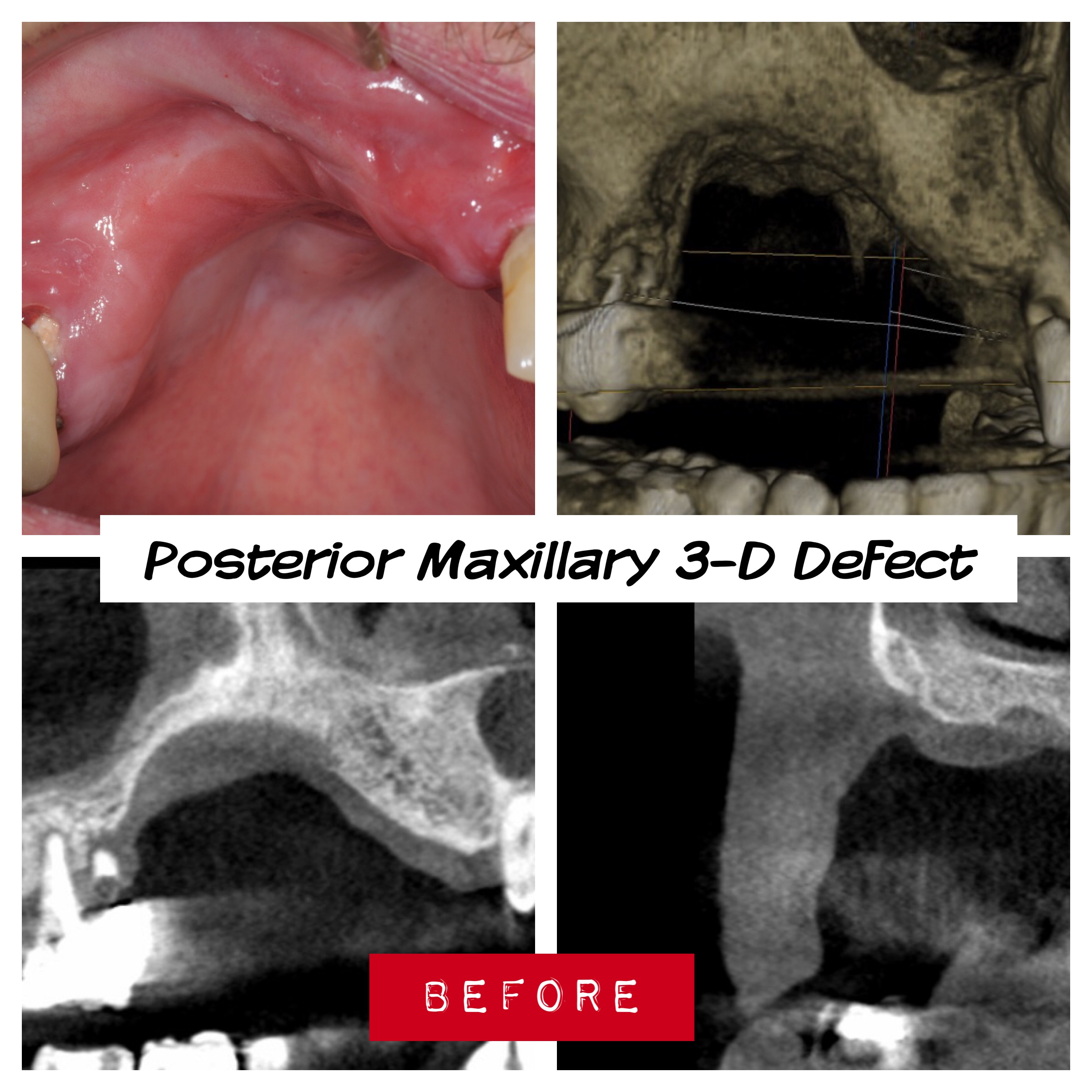1.-posterior-maxilla-defect-before-osteogenesis-distraction-guided-bone-regeneration-kazemi-oral-surgery-dental-implants