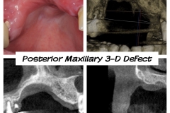 1.-posterior-maxilla-defect-before-osteogenesis-distraction-guided-bone-regeneration-kazemi-oral-surgery-dental-implants