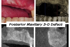 2.-posterior-maxilla-defect-after-osteogenesis-distraction-guided-bone-regenerationkazemi-oral-surgery-dental-implants