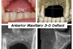 5.-anterior-maxilla-defect-before-failed-bone-graft-complications-kazemi-oral-surgery-dental-implants