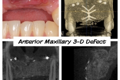 6.-anterior-maxilla-defect-after-failed-bone-graft-complications-kazemi-oral-surgery-dental-implants