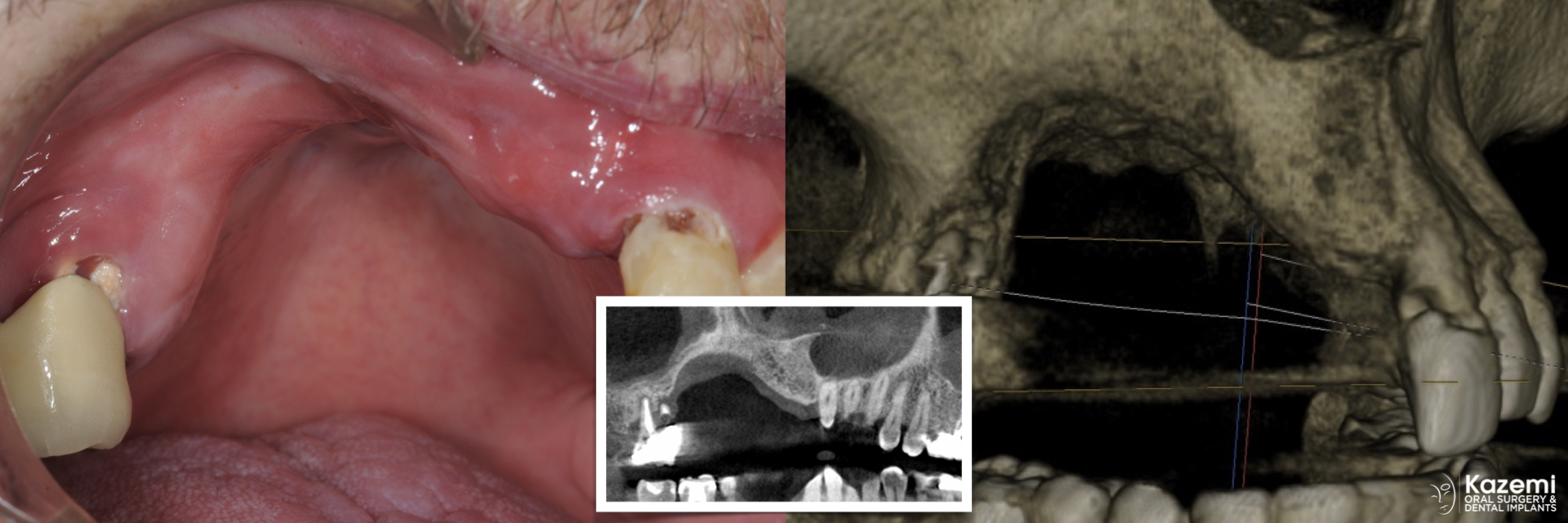 1.-maxillary-3-d-deficiency-osteogenesis-distraction-onlay-bone-graft-dental-implants-kazemi-oral-surgery-1