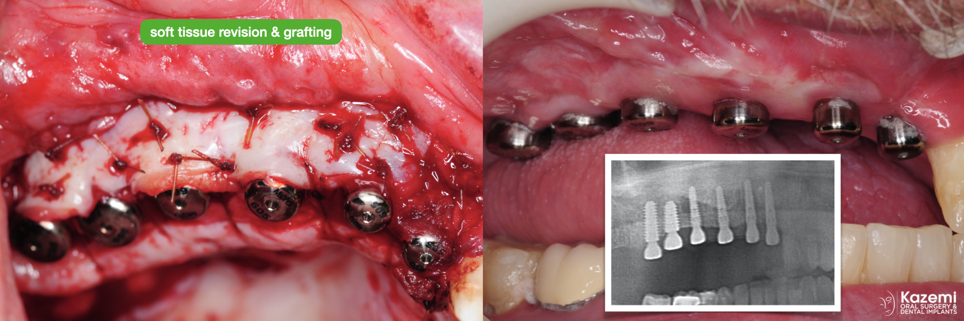 3.-gingival-revision-graft-vestibuloplasty-keratinized-gingiva-dental-implants-kazemi-oral-surgery-1