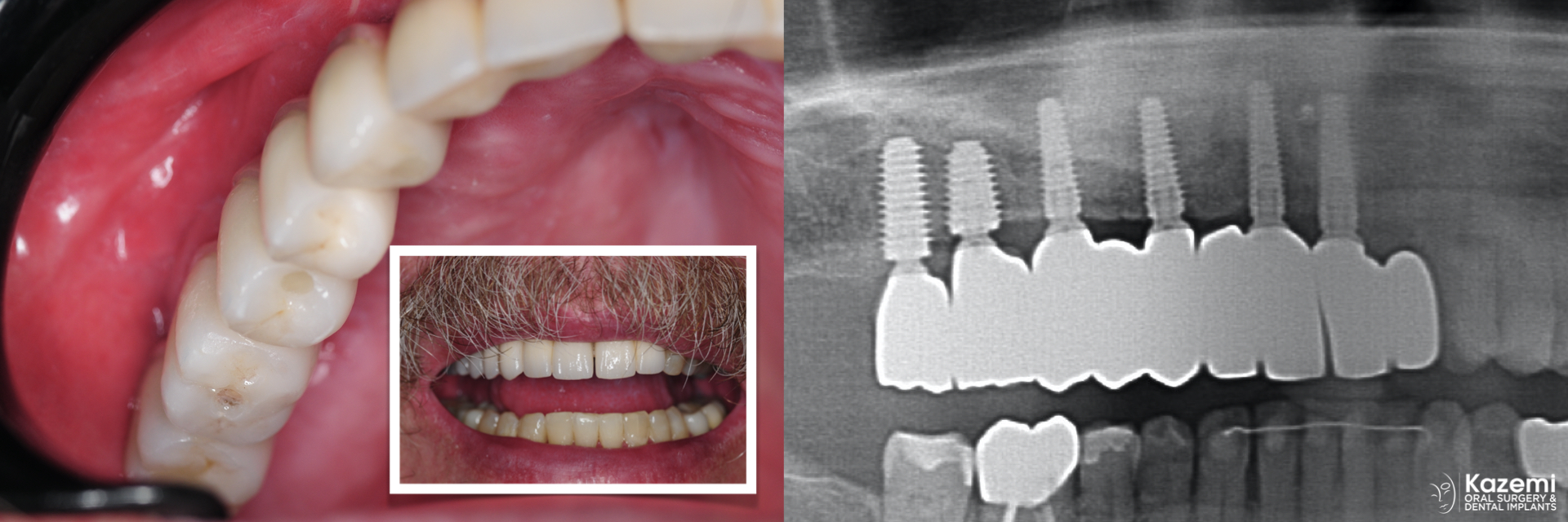 4.-maxillary-3-d-deficiency-osteogenesis-distraction-onlay-bone-graft-dental-implants-kazemi-oral-surgery
