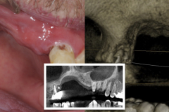 1.-maxillary-3-d-deficiency-osteogenesis-distraction-onlay-bone-graft-dental-implants-kazemi-oral-surgery-1