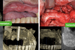 2.-maxillary-3-d-deficiency-osteogenesis-distraction-onlay-bone-graft-dental-implants-kazemi-oral-surgery-2