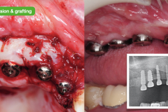 3.-gingival-revision-graft-vestibuloplasty-keratinized-gingiva-dental-implants-kazemi-oral-surgery-1