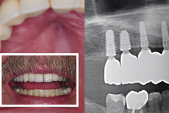 4.-maxillary-3-d-deficiency-osteogenesis-distraction-onlay-bone-graft-dental-implants-kazemi-oral-surgery
