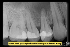 dental-cyst-peri-apical-granuloma-excision-removal-enucleation-bone-graft-for-dental-implant-kazemi-oral-surgery-2.001
