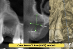 dental-cyst-peri-apical-granuloma-excision-removal-enucleation-bone-graft-for-dental-implant-kazemi-oral-surgery-2.002