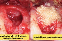 dental-cyst-peri-apical-granuloma-excision-removal-enucleation-bone-graft-for-dental-implant-kazemi-oral-surgery-2.003
