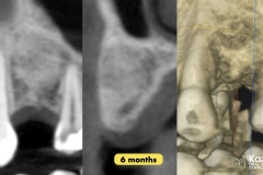 dental-cyst-peri-apical-granuloma-excision-removal-enucleation-bone-graft-for-dental-implant-kazemi-oral-surgery-2.004