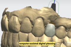 dental-cyst-peri-apical-granuloma-excision-removal-enucleation-bone-graft-for-dental-implant-kazemi-oral-surgery-2.005