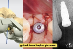 dental-cyst-peri-apical-granuloma-excision-removal-enucleation-bone-graft-for-dental-implant-kazemi-oral-surgery-2.007