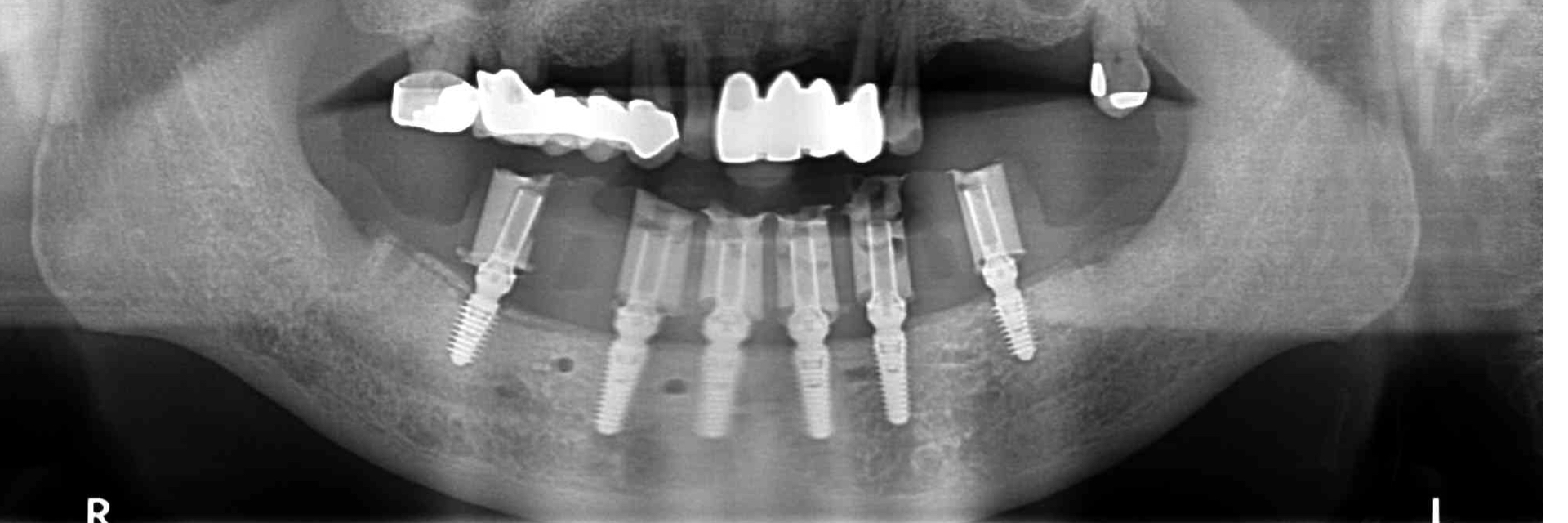 Digital-Workflow-for-Full-Arch-Implant-Supported-Teeth-Chrome-GuidedSmile-Kazemi-Oral-Surgery-Bethesda-Implant-Dentist.015