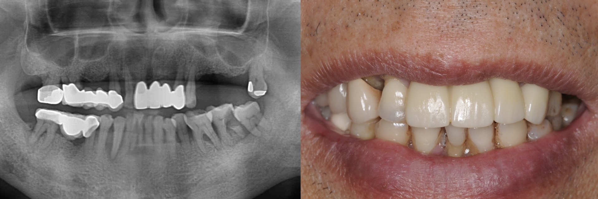 Digital-Workflow-for-Full-Arch-Implant-Supported-Teeth-Chrome-GuidedSmile-Kazemi-Oral-Surgery-Bethesda-Implant-Dentist.002