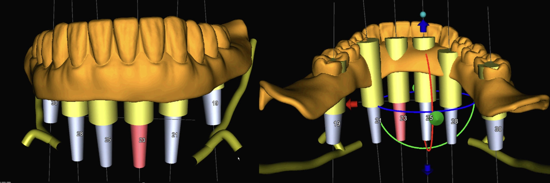 Digital-Workflow-for-Full-Arch-Implant-Supported-Teeth-Chrome-GuidedSmile-Kazemi-Oral-Surgery-Bethesda-Implant-Dentist.010