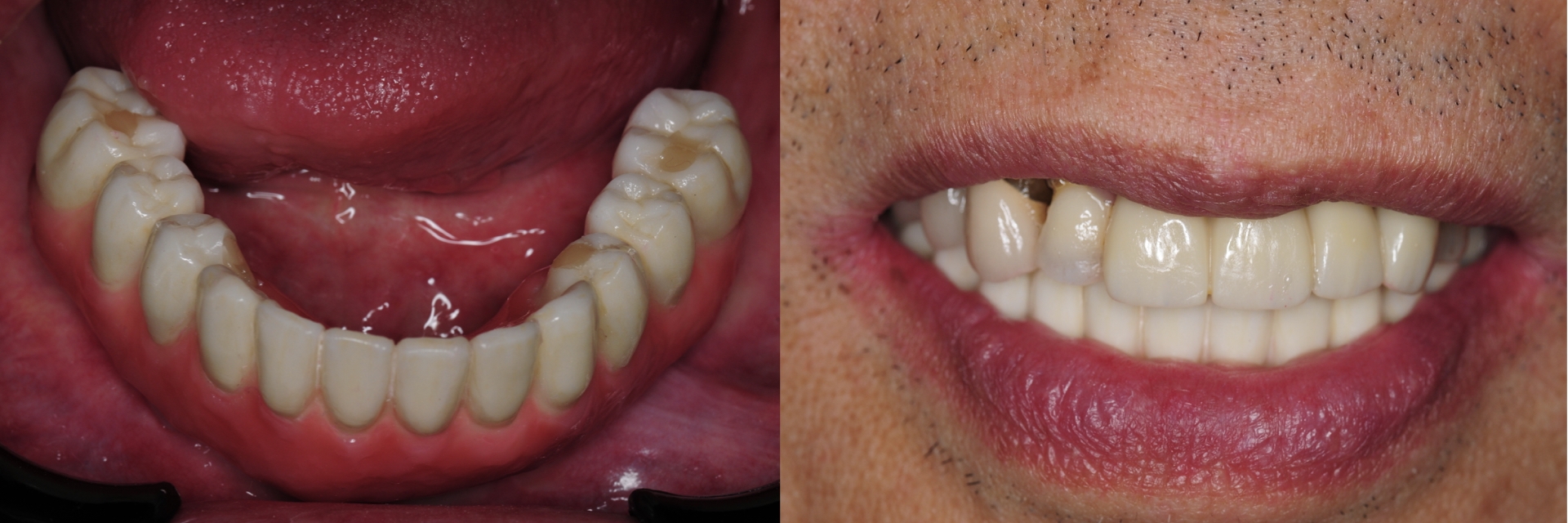 Digital-Workflow-for-Full-Arch-Implant-Supported-Teeth-Chrome-GuidedSmile-Kazemi-Oral-Surgery-Bethesda-Implant-Dentist.018