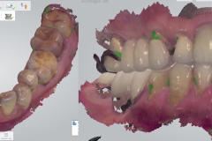 1_Digital-Workflow-for-Full-Arch-Implant-Supported-Teeth-Chrome-GuidedSmile-Kazemi-Oral-Surgery-Bethesda-Implant-Dentist.006