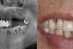 Digital-Workflow-for-Full-Arch-Implant-Supported-Teeth-Chrome-GuidedSmile-Kazemi-Oral-Surgery-Bethesda-Implant-Dentist.002