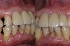 Digital-Workflow-for-Full-Arch-Implant-Supported-Teeth-Chrome-GuidedSmile-Kazemi-Oral-Surgery-Bethesda-Implant-Dentist.003