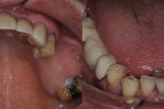 Digital-Workflow-for-Full-Arch-Implant-Supported-Teeth-Chrome-GuidedSmile-Kazemi-Oral-Surgery-Bethesda-Implant-Dentist.004