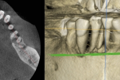 Digital-Workflow-for-Full-Arch-Implant-Supported-Teeth-Chrome-GuidedSmile-Kazemi-Oral-Surgery-Bethesda-Implant-Dentist.005