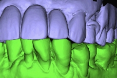 Digital-Workflow-for-Full-Arch-Implant-Supported-Teeth-Chrome-GuidedSmile-Kazemi-Oral-Surgery-Bethesda-Implant-Dentist.007