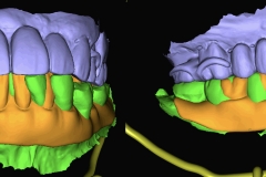 Digital-Workflow-for-Full-Arch-Implant-Supported-Teeth-Chrome-GuidedSmile-Kazemi-Oral-Surgery-Bethesda-Implant-Dentist.008