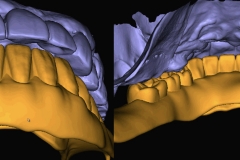Digital-Workflow-for-Full-Arch-Implant-Supported-Teeth-Chrome-GuidedSmile-Kazemi-Oral-Surgery-Bethesda-Implant-Dentist.009