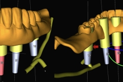 Digital-Workflow-for-Full-Arch-Implant-Supported-Teeth-Chrome-GuidedSmile-Kazemi-Oral-Surgery-Bethesda-Implant-Dentist.010