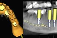 Digital-Workflow-for-Full-Arch-Implant-Supported-Teeth-Chrome-GuidedSmile-Kazemi-Oral-Surgery-Bethesda-Implant-Dentist.011