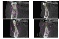 Digital-Workflow-for-Full-Arch-Implant-Supported-Teeth-Chrome-GuidedSmile-Kazemi-Oral-Surgery-Bethesda-Implant-Dentist.012