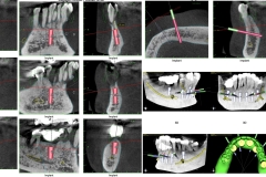 Digital-Workflow-for-Full-Arch-Implant-Supported-Teeth-Chrome-GuidedSmile-Kazemi-Oral-Surgery-Bethesda-Implant-Dentist.013