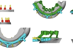 Digital-Workflow-for-Full-Arch-Implant-Supported-Teeth-Chrome-GuidedSmile-Kazemi-Oral-Surgery-Bethesda-Implant-Dentist.014