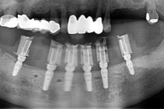 Digital-Workflow-for-Full-Arch-Implant-Supported-Teeth-Chrome-GuidedSmile-Kazemi-Oral-Surgery-Bethesda-Implant-Dentist.015