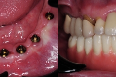 Digital-Workflow-for-Full-Arch-Implant-Supported-Teeth-Chrome-GuidedSmile-Kazemi-Oral-Surgery-Bethesda-Implant-Dentist.016