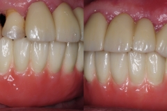 Digital-Workflow-for-Full-Arch-Implant-Supported-Teeth-Chrome-GuidedSmile-Kazemi-Oral-Surgery-Bethesda-Implant-Dentist.017