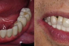 Digital-Workflow-for-Full-Arch-Implant-Supported-Teeth-Chrome-GuidedSmile-Kazemi-Oral-Surgery-Bethesda-Implant-Dentist.018